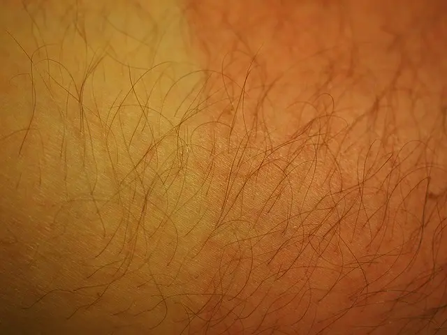Eritemas solares o quemaduras